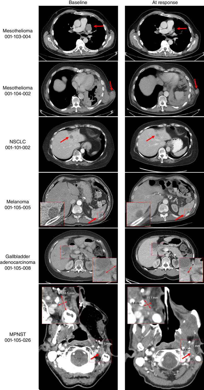 Figure 6. Activity of MRTX1719 in patients with MTAP del cancers. Mesothelioma patient 001-103-004: Pretreatment and follow-up (FU) C6D20 scans, indicating 56% reduction of target lesions, including the pleural disease shown here. The patient continues on study. Mesothelioma patient 001-104-002: Activity of MRTX1719 in patient epithelioid mesothelioma with MTAP deletion. Pretreatment and FU 3 scans, indicating 30% reduction of target lesions, including soft tissue lesions shown here. The patient continues on study. NSCLC patient 001-101-002: Baseline: dominant mass left hepatic dome measuring 29 × 19 mm, previous 20 × 19 mm. Stable other tiny scattered hypodense hepatic lesions too small to accurately characterize. C5D1: left hepatic dome metastasis, measuring 17 × 17 mm. Stable and mild decreasing size of hepatic metastases. The patient continues on study. Melanoma patient 001-105-005: Baseline and cycle 9 scans of a patient with MTAP del melanoma. Partial response was confirmed at cycle 9, and the patient continues on study. Gallbladder adenocarcinoma patient 001-105-008: Pretreatment and cycle 9 scans of a patient with treatment-refractory MTAP loss gallbladder indicating 43% reduction of target lesions. The patient continues on study. MPNST patient 001-105-026: Patient received MRTX1719 800 mg q.d. Restaging after 4 cycles shows a partial response with a 38.9% decrease of target lesions. The patient continues on study.