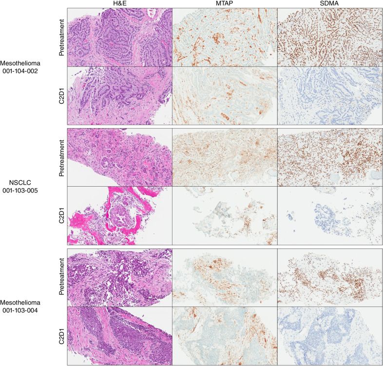 Figure 5. PRMT5-mediated SDMA modification in MTAP del patient tumor biopsies is extinguished following daily oral administration of 200 mg MRTX1719. Pretreatment and C2D1 tumor biopsies were stained for MTAP and SDMA protein expression by IHC. Adjacent slides were also stained with hematoxylin and eosin (H&E). MTAP and SDMA H-scores were determined by a pathologist and scored in Supplementary Fig. S7A.