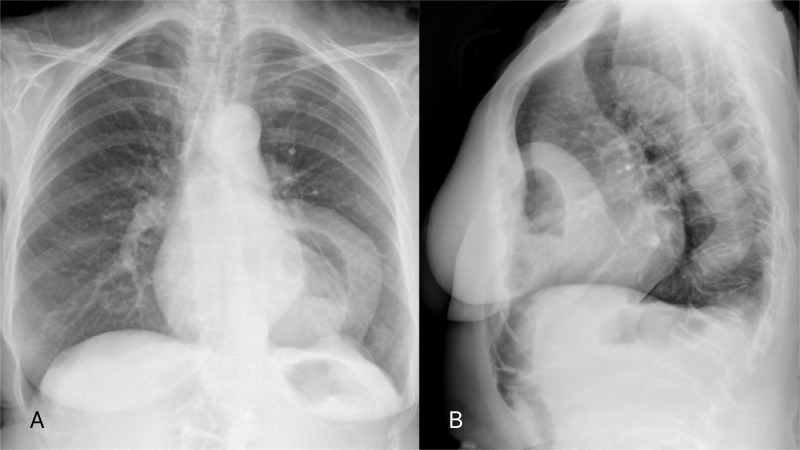 Laparoscopic repair of a Morgagni hernia with extra-abdominal ...