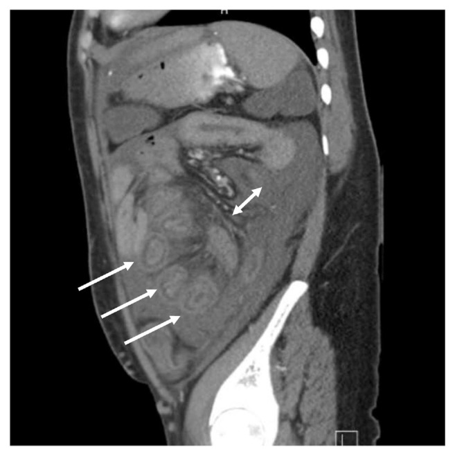 Lupus Enteritis In The Absence Of A Lupus Flare. A Case Report And 