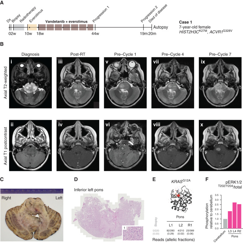 Figure 5. Clinical experience of combined vandetanib and everolimus in a 7-year-old girl with ACVR1-mutant DIPG (case 1). A, Timeline summarizing the clinical history of case 1, treated at the Royal Marsden Hospital, London, United Kingdom. *Imaging scans presented in B. Dx, diagnosis. B, Sequential head MRI scans: diagnostic MRI showing diffuse heterogenous tumor infiltration and anatomic distortion of the pons, including partial invagination of the basilar artery (i) with a single focus of intratumoral enhancement in the right central pons (ii); MRI scan 6 weeks after radiotherapy (RT) showed considerable reduction in tumor infiltrative bulk (iii) with the small focus of enhancement persisting in the right pons (iv); the MRI scan after three cycles of everolimus single agent constituted also the baseline scan prior to starting vandetanib/everolimus, and it showed increased T2 signal abnormality in the right pons (v) associated with mildly increased focal enhancement (vi); the MRI scans after three cycles (vii, viii) and six cycles (ix, x) of vandetanib/everolimus showed modest enlargement and progressive infiltration of the right pons (vii, ix) with concomitant increase of the associated focal enhancement (viii, x) but nevertheless with relatively stable appearances/lack of progression elsewhere. The child started cycle 7 of vandetanib/everolimus but then developed worsening symptoms (slurred speech, ataxia), and treatment was permanently discontinued 11 months after initial diagnosis. No further systemic treatment or reirradiation was administered. The child could be weaned off steroids completely, and her balance and activity levels improved significantly. Eight months after discontinuation of vandetanib/everolimus, she developed further clinical and radiologic progression (local and metastatic) and died a month later (OS, 20 months). C, Macroscopic transverse cross section of pons and cerebellum from the brain autopsy specimen from case 1. D, Hematoxylin and eosin–stained image from the inferior left pons (×40), with a higher magnification inset (×200) of region 1, showing diffuse infiltration of tumor cells. E, Protein structure representation of KRAS showing mutant G12A residue (shaded red), generated in COSMIC-3D (https://cancer.sanger.ac.uk/cosmic3d/). Allelic fractions are provided for mutant reads identified in distinct areas of the pons taken at autopsy. F, MAPK pathway activation in distinct autopsy regions measured by quantitative capillary electrophoresis for phospho-ERK1/2T202/Y204, plotted as a ratio of respective phosphorylated/total protein compared with normal cerebellum.