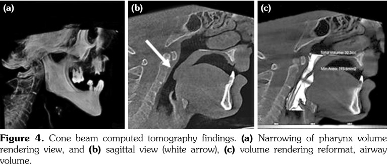 Multiple Major and Minor Anomalies Associated With Klippel-Feil ...