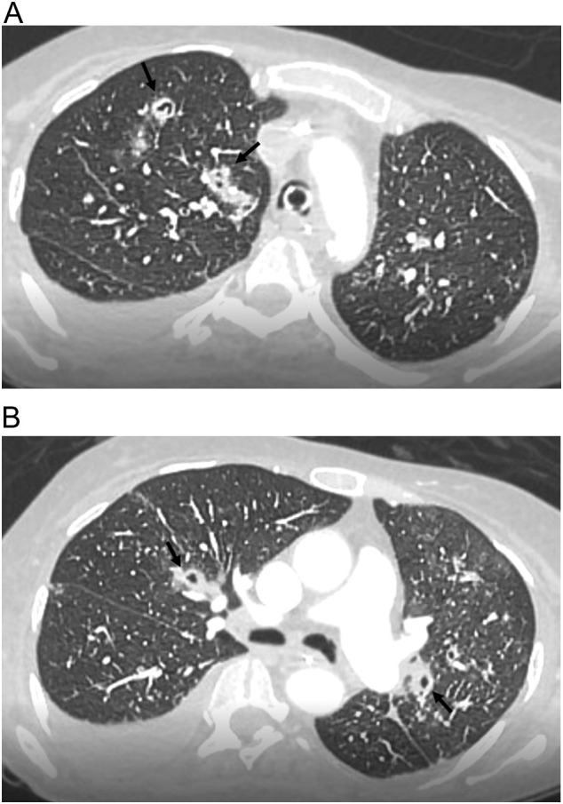 Ct Findings Of Covid-19-associated Pulmonary Aspergillosis: A 