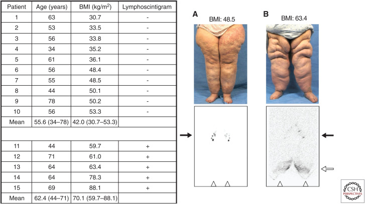 Lymphedema and Obesity - PMC