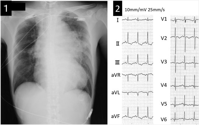 A Case Of Descending Aortic Dissection In A Patient With Unrepaired 