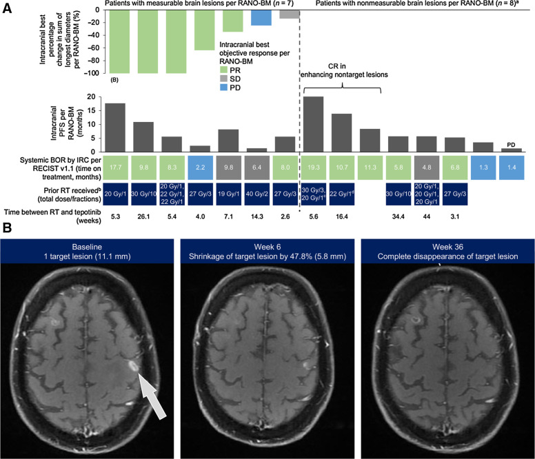 Figure 3. Intracranial responses to tepotinib assessed by IRC according to RANO-BM criteria. A, Waterfall plot depicting intracranial best change in sum of longest diameters (patients with measurable lesions only), and intracranial PFS. B, MRI images showing response to tepotinib in an intracranial target lesion per RANO-BM criteria; this patient is indicated in A. a7 of 8 patients with non-measurable brain lesions achieved intracranial disease control; 1 patient had intracranial BOR of PD (indicated on graph). bRT for brain lesions. c20 Gy in 1 fraction was reported during the same time period as 30 Gy in 3 fractions. dGamma Knife was also received 31.4 weeks prior to the start of tepotinib treatment. Gy, Gray (unit); RT, radiotherapy.