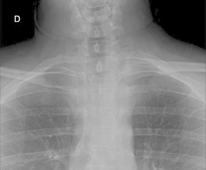 Sternoclavicular Dislocation: Case Report And Surgical Technique - Pmc