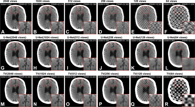 Axial CT image (512 × 512 pixels) from the test set labeled as “healthy.” (A–F) Images show the filtered back projection reconstruction from 2048, 1024, 512, 256, 128, and 64 views, respectively. (G–L) Images show the U-Net predictions of the respective images in the upper row, and (M–R) images show the results of the total variation (TV)–based method. The presented structural similarity index measure (SSIM) and peak signal-to-noise ratio (PSNR) values were calculated over the entire CT image scaled to [0–1] from the full Hounsfield unit range (−1024 to 3071 HU) with respect to the 4096-view reconstruction. All images are presented in the brain window ranging from 0 HU to 80 HU. The insert is 100 × 100 pixels; the entire image is 512 × 512 pixels.