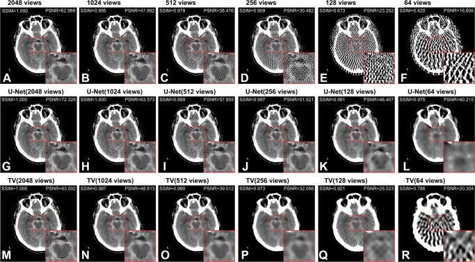 Axial CT image (512 × 512 pixels) from the test set labeled with a subarachnoid hemorrhage. (A–F) Images show the filtered back projection reconstruction from 2048, 1024, 512, 256, 128, and 64 views, respectively. (G–L) Images show the U-Net predictions of the respective images in the upper row, and (M–R) images show the results of the total variation (TV)–based method. The presented structural similarity index measure (SSIM) and peak signal-to-noise ratio (PSNR) values were calculated over the entire CT image scaled to [0–1] from the full Hounsfield unit range (−1024 to 3071 HU) with respect to the 4096-view reconstruction. All images are presented in the brain window ranging from 0 HU to 80 HU. The insert is 100 × 100 pixels; the entire image is 512 × 512 pixels.