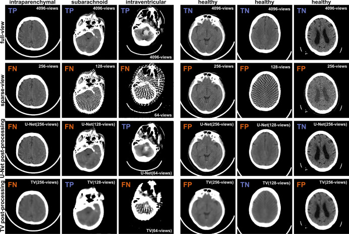 Examples of detection results of individual axial sections by the EfficientNet-B2 network. Each column displays a full-view image, followed by its corresponding sparse-view reconstruction, and then the sparse-view image postprocessed, either by the U-Net or the total variation (TV) algorithm. The first three columns depict images labeled with intraparenchymal, subarachnoid, and intraventricular hemorrhages, respectively, while the last three columns show images labeled as healthy. In the upper left corner of each image, it is indicated whether the images were correctly classified (true positive [TP] or true negative [TN]) or not (false negative [FN] or false positive [FP]), utilizing the same thresholds as for the confusion matrices in Figure 7. All images are presented in the brain window ranging from 0 HU to 80 HU.