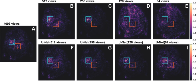 Saliency maps by the EfficientNet-B2 model of the CT images of Figure 3 with regard to the “any” class. (A) Image shows the saliency map of the full-view image. (B–E) Images show the saliency maps of the images reconstructed from 512, 256, 128, and 64 views, respectively. (F–H) Images show the saliency maps of the images postprocessed by the U-Net of the corresponding sparse-view images. All maps were normalized via min-max normalization to range [0–1]. The rectangles are at the same position as in Figure 3, indicating the location of the present hemorrhages. Note: Saliency maps were generated by analyzing the gradients of the EfficientNet-B2 model with respect to the input. High values indicate that changes to those pixels have a substantial impact on the model's output, and therefore, those pixels are most important for the prediction.