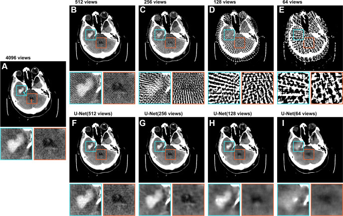 Axial CT image (512 × 512 pixels) from the test set labeled with an intraparenchymal (cyan arrow) and an intraventricular (orange arrow) hemorrhage. The top row displays raw images, and the bottom row demonstrates artifact reduction by the U-Net. The labeled intraparenchymal and intraventricular hemorrhages are shown in detail in the zoomed-in extracts. (A) Image shows the image reconstructed from 4096 views. (B–E) Images show the same image reconstructed from 512, 256, 128, and 64 views, respectively. (F–I) Images show the U-Net predictions of the corresponding sparse-view images in the upper row. All images are presented in the brain window ranging from 0 HU to 80 HU. Both inserts are 80 × 80 pixels.