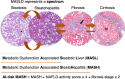 MASLD spectrum. Conventional histologic images show steatosis with fat
droplets within hepatocytes (*), steatohepatitis with ballooned
hepatocytes (B), early-stage fibrotic liver with pericellular fibrosis
(black arrow), and cirrhotic liver with fibrotic scars (yellow arrow)
surrounding a regenerative nodule (N). MASL refers to steatosis without
inflammation or cell injury. MASH refers to steatosis with inflammation and
cell injury. Fibrosis refers to excess collagen deposition in the
extracellular matrix and is a marker of cumulative liver damage. Cirrhosis
is a late stage of disease in which fibrotic scars have carved the liver
into regenerative nodules. At-risk MASH is defined by the combination of
MASH, an NAFLD activity score of 4 or greater, and a fibrosis score of 2 or
greater. NAFLD activity score is the sum of the steatosis grade
(0–3), lobular inflammation grade (0–3), and ballooning score
(0–2). (Hematoxylin-eosin stain [two left images] and trichrome stain
[two right images].)