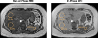 SLD by conventional MRI in a 59-year-old woman. Axial out-of-phase MR
image (left) shows that the liver is hypointense compared with the liver on
the in-phase MR image (right). Note that fat deposition is heterogeneous
throughout the liver.