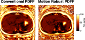 Solutions to patient tolerance barrier: motion-robust PDFF
acquisitions to enable free breathing. A child with MASLD was unable to hold
their breath during a 15-second conventional PDFF acquisition (left). Repeat
PDFF was performed using an investigational motion- robust sequence during
free breathing (right). Image degradation by motion artifact on the axial
conventional PDFF image is substantially improved on the axial motion-robust
image.