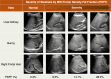 Chart shows conventional US images for SLD in four different pediatric
patients (each column shows images in one patient), each with three B-mode
US views. The corresponding PDFF percentage value for each patient’s
liver is noted in the last row. In all three cases with steatosis, the liver
is brighter than the kidney and there is blurring of the vessels. While
qualitative assessment of B-mode US images can help identify patients with
steatosis, it cannot discriminate the severity of steatosis. Bunny = bunny
waveform.