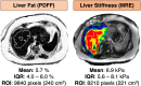 Solutions to site experience barrier: automated PDFF and MRE analysis.
Axial images show liver fat (outlines) PDFF (left) and liver stiffness from
MRE (right) analyzed automatically from PDFF and MRE stiffness maps,
respectively. IQR = interquartile range, ROI = region of interest. (Image
courtesy of Richard Ehman, MD, Mayo Clinic, Rochester, Minnesota, and
Resoundant.)