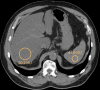 SLD by noncontrast CT in a 66-year-old man. Axial noncontrast CT image
shows the liver with attenuation of 20.7 HU and the spleen with attenuation
of 43.6 HU. Note that the vessels appear to have more attenuation than the
liver due to elevated fat deposition within the liver tissue. In extreme
cases, the vessels may appear so bright compared with the liver that it can
resemble a contrast-enhanced image.