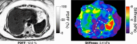 MRI for assessment of hepatic steatosis and fibrosis in a 60-year-old
woman with biopsy-proven at-risk MASH. Axial MRI PDFF map (left) shows a fat
fraction of 12%, and axial 2D MRE stiffness map (right) shows a stiffness of
3.4 kPa. Cardiometabolic factors for MASLD diagnosis included elevated body
mass index (26.9 kg/m2) and elevated fasting blood glucose levels. The
patient’s alcohol use was less than one drink per week. Serum
aspartate aminotransferase (AST) and alanine aminotransferase (ALT) levels
were elevated, and the FIB-4 score was 2.0. Note that as fibrosis increases,
steatosis can decrease (compared with Figure 16).