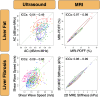 Reproducibility problem. Reproducibility plots on the left show poor
agreement among US vendors for measuring the same US-based biomarkers in
adults with known or suspected MASLD (left) including attenuation
coefficient (AC) (top left) and shear wave speed (bottom left) in a study by
Pierce et al (65). Different colors correspond to paired comparison of
values achieved from two different vendors for the same research
participants. For AC, four leading vendors were compared, with an intraclass
correlation coefficient (ICC) ranging from -0.04 to 0.49. For shear wave
speed, five leading vendors were compared, with an ICC ranging from -0.09 to
0.68. For comparison, reproducibility plots on the right show good agreement
among MRI vendors for measuring MRI-based biomarkers in adults with known or
suspected MASLD including PDFF (top right) and two-dimensional (2D) MRE
stiffness (bottom right) in a study by Fowler et al (64). For PDFF, three
leading vendors were compared at two field strengths (3 T and 1.5 T), with
ICC ranging from 0.97 to 0.98. For 2D MRE stiffness, three leading vendors
were compared at two field strengths (3 T and 1.5 T), with ICC ranging from
0.96 to 0.99. Perfect agreement would be ICC of 1.0.