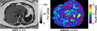 MRI for assessment of hepatic steatosis and fibrosis in a 48-year-old
woman with biopsy-proven nonfibrotic MASH. Axial MRI PDFF map (left) shows a
fat fraction of 31.9%, and the axial two-dimensional (2D) MR elastography
(MRE) stiffness map (right) shows a stiffness of 2.0 kPa. Note the
visibility of the hepatic vessels on the MRI PDFF map due to elevated fat
deposition within the liver. Cardiometabolic factors for MASLD diagnosis
included elevated body mass index (39.8 kg/m2), elevated hemoglobin A1c
levels, and hypertriglyceridemia. The patient’s alcohol use was less
than one drink per week. Serum asparate aminotransferase (AST) and alanine
aminotransferase (ALT) levels were elevated, and the FIB-4 score was
0.90.