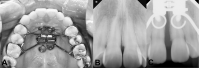 Figure 2. Fixation of the miniscrew-assisted rapid maxillary expansion (MARME) device and periapical views before and after expansion. (A) A MARME appliance. (B) Before expansion. (C) After 2 weeks of expansion, a diastema caused by splitting of the midpalatal suture can be observed.