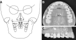 Figure 3. Skeletal and dental measurements. (A) N-N, nasal cavity width; J-J, maxillary width; Ma-Ma, middle alveolus width. (B) ICW, intercanine width; IPMW, interpremolar width; IMW, intermolar width; CH3, clinical crown height of the canine; CH4, clinical crown height of the first premolar; CH6, clinical crown height of the first molar.