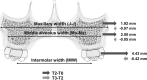 Figure 5. Schematic diagram after MARME. T0, at the initial examination; T2, immediately after debonding; T3, at posttreatment.