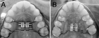 Figure 1. (A) Tooth-borne expander (Hyrax-type) and (B) tooth-tissue–borne expander (Haas-type).