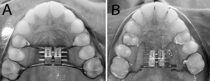 Figure 1. (A) Tooth-borne expander (Hyrax-type) and (B) tooth-tissue–borne expander (Haas-type).