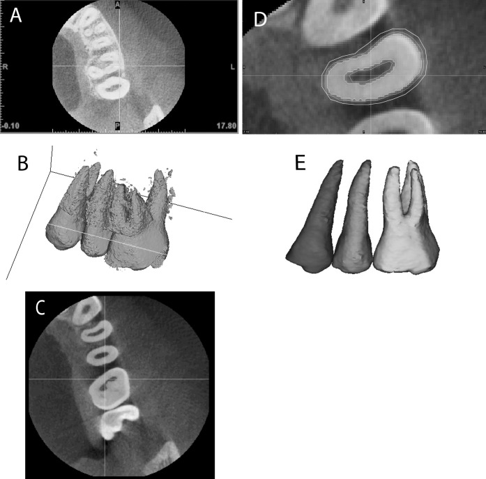 Figure 2. Segmentation and volumetric measurement: (A) Selecting the optimal threshold; (B) Edit mask in 3-D; (C) Edit mask in 2-D; (D, E) 3-D reconstruction.