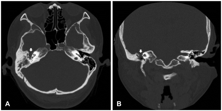 Repair of Spontaneous Cerebrospinal Fluid Otorrhea from Defect of ...