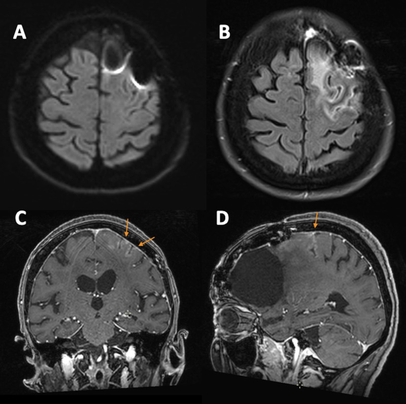 Brain MRI at presentation with no evidence of restriction of diffusion (A). Marked left posterior frontal gyral edema on axial FLAIR (B) associated with cortical gyriform gadolinium enhancement on coronal and sagittal T1-weighted (C-D)