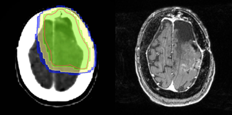 Radiotherapy dose distribution with correlating axial post-contrast T1-weighted image demonstrating the cortical enhancement at presentation