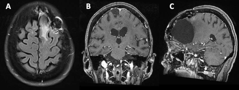 Complete resolution of findings one month later on axial FLAIR (A), coronal and sagittal postcontrast T1-weighted imaging (B – C)