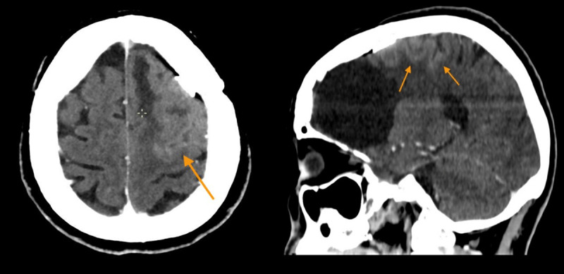 Axial and sagittal CT section shows corticopial enhancement in the left posterior frontal lobe surrounding the resection cavity