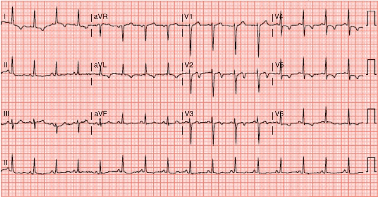 Recognizing Wellens’ syndrome, a warning sign of critical proximal LAD ...