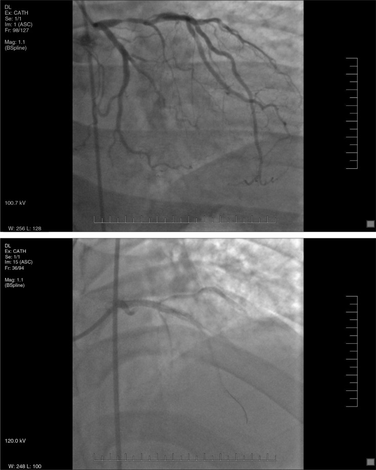 Recognizing Wellens’ syndrome, a warning sign of critical proximal LAD ...