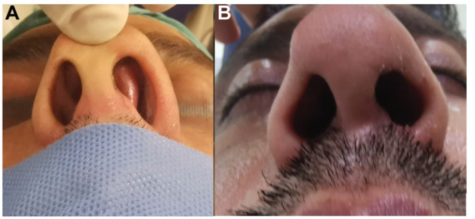 Fashioned Mucoperichondrium Flap Technique in Caudal Septal Deviation - PMC