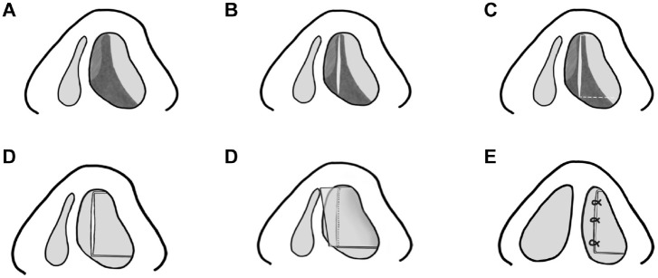 Fashioned Mucoperichondrium Flap Technique in Caudal Septal Deviation - PMC