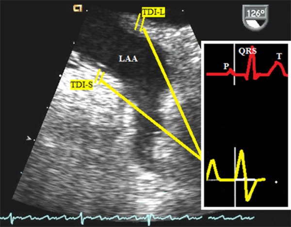 Techniques To Improve Left Atrial Appendage Imaging Pmc