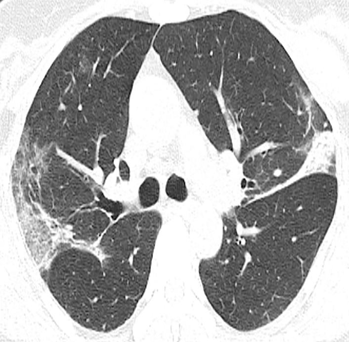 (a) Note the peripheral predominant airspace opacities with a reversed halo pattern in the left upper lobe (arrow). (b, c) Organizing changes with increasing attenuation are noted on follow-up CT images.