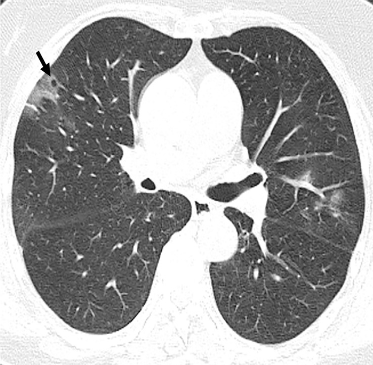 (a) Axial chest CT image at presentation shows a small solitary nodular ground-glass opacity in left upper lobe (arrow). (b, c) Note the progression of airspace disease 3 days later, with new foci of ground-glass opacities (black arrows, b, c), as well as developing consolidation (white arrow). Additionally, there is higher peripheral attenuation with ground-glass opacities more centrally representing the reversed halo sign (curved arrows, c). (d, e) Further increase in extent of ground glass changes with new cavity in right lung (arrow, d) as well as new areas of consolidation (arrow, e) are seen on CT images 5 days after presentation.