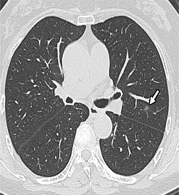 (a) Axial chest CT image at presentation shows a small solitary nodular ground-glass opacity in left upper lobe (arrow). (b, c) Note the progression of airspace disease 3 days later, with new foci of ground-glass opacities (black arrows, b, c), as well as developing consolidation (white arrow). Additionally, there is higher peripheral attenuation with ground-glass opacities more centrally representing the reversed halo sign (curved arrows, c). (d, e) Further increase in extent of ground glass changes with new cavity in right lung (arrow, d) as well as new areas of consolidation (arrow, e) are seen on CT images 5 days after presentation.