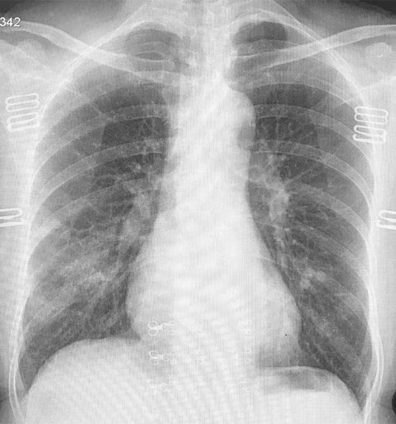 (a) Chest radiograph in a patient with COVID-19 infection demonstrates right infrahilar airspace opacities. (b) Axial and (c) sagittal chest CT images demonstrate peripheral right lower lobe ground-glass opacities. Follow-up (d) axial and (e) sagittal chest CT images 2 days later show improvement in the extent of ground-glass opacities, with more subpleural curvilinear lines (arrows).