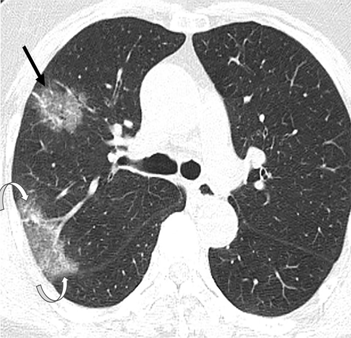 (a) Axial chest CT image at presentation shows a small solitary nodular ground-glass opacity in left upper lobe (arrow). (b, c) Note the progression of airspace disease 3 days later, with new foci of ground-glass opacities (black arrows, b, c), as well as developing consolidation (white arrow). Additionally, there is higher peripheral attenuation with ground-glass opacities more centrally representing the reversed halo sign (curved arrows, c). (d, e) Further increase in extent of ground glass changes with new cavity in right lung (arrow, d) as well as new areas of consolidation (arrow, e) are seen on CT images 5 days after presentation.