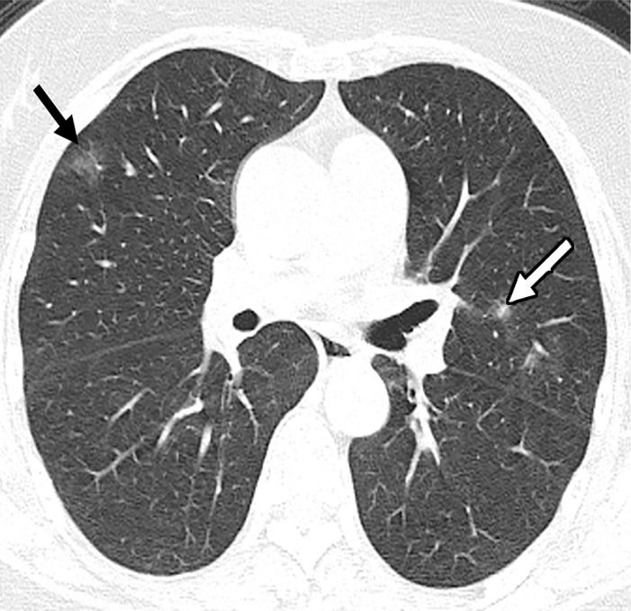 (a) Axial chest CT image at presentation shows a small solitary nodular ground-glass opacity in left upper lobe (arrow). (b, c) Note the progression of airspace disease 3 days later, with new foci of ground-glass opacities (black arrows, b, c), as well as developing consolidation (white arrow). Additionally, there is higher peripheral attenuation with ground-glass opacities more centrally representing the reversed halo sign (curved arrows, c). (d, e) Further increase in extent of ground glass changes with new cavity in right lung (arrow, d) as well as new areas of consolidation (arrow, e) are seen on CT images 5 days after presentation.