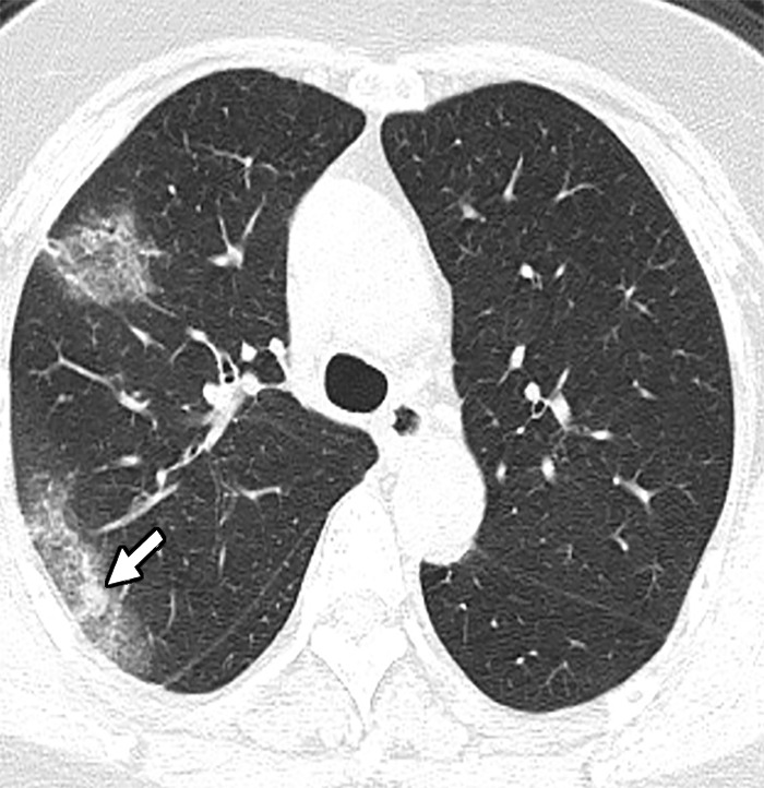 (a) Axial chest CT image at presentation shows a small solitary nodular ground-glass opacity in left upper lobe (arrow). (b, c) Note the progression of airspace disease 3 days later, with new foci of ground-glass opacities (black arrows, b, c), as well as developing consolidation (white arrow). Additionally, there is higher peripheral attenuation with ground-glass opacities more centrally representing the reversed halo sign (curved arrows, c). (d, e) Further increase in extent of ground glass changes with new cavity in right lung (arrow, d) as well as new areas of consolidation (arrow, e) are seen on CT images 5 days after presentation.