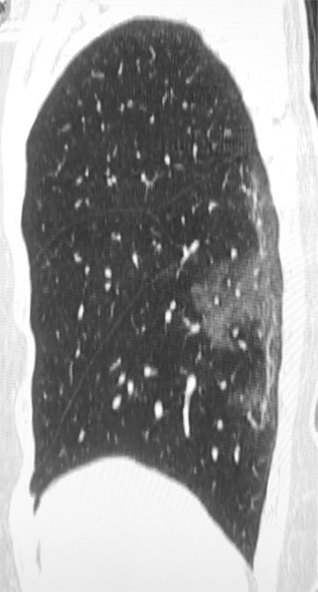 (a) Chest radiograph in a patient with COVID-19 infection demonstrates right infrahilar airspace opacities. (b) Axial and (c) sagittal chest CT images demonstrate peripheral right lower lobe ground-glass opacities. Follow-up (d) axial and (e) sagittal chest CT images 2 days later show improvement in the extent of ground-glass opacities, with more subpleural curvilinear lines (arrows).