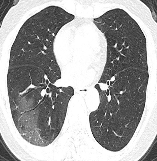 (a) Chest radiograph in a patient with COVID-19 infection demonstrates right infrahilar airspace opacities. (b) Axial and (c) sagittal chest CT images demonstrate peripheral right lower lobe ground-glass opacities. Follow-up (d) axial and (e) sagittal chest CT images 2 days later show improvement in the extent of ground-glass opacities, with more subpleural curvilinear lines (arrows).